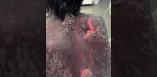 Шымкентские врачи спасли женщину после опасного самолечения