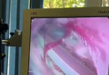 В Шымкенте мужчина проглотил 26 ручек на спор Эндоскопия