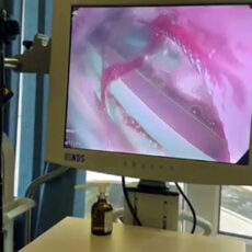 В Шымкенте мужчина проглотил 26 ручек на спор Эндоскопия