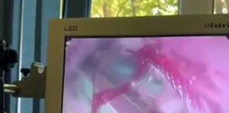 В Шымкенте мужчина проглотил 26 ручек на спор Эндоскопия