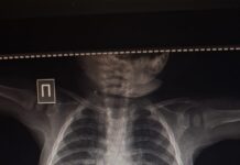 Иголку в брюшной полости 8-месячного ребенка обнаружили врачи