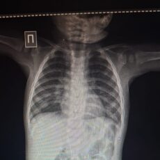 Иголку в брюшной полости 8-месячного ребенка обнаружили врачи