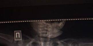 Иголку в брюшной полости 8-месячного ребенка обнаружили врачи