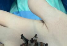 В Шымкенте врачи удалили необычный крупный камень и сохранили почку