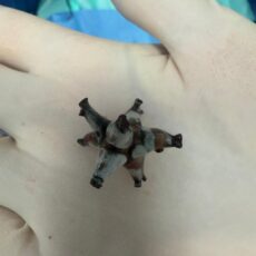 В Шымкенте врачи удалили необычный крупный камень и сохранили почку