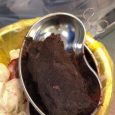 Почти 1 кг волос нашли в желудке у подростка в Туркестанской области