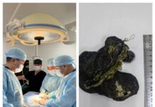 Врачи извлекли из желудка 8-летнего пациента крупный ком волос