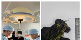 Врачи извлекли из желудка 8-летнего пациента крупный ком волос