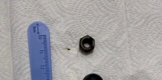 Врачи извлекли магнит и металлические предметы из кишечника ребенка