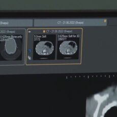 ИИ помогает врачам Казахстана быстрее выявлять инсульт и онкологию