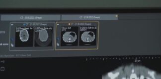 ИИ помогает врачам Казахстана быстрее выявлять инсульт и онкологию