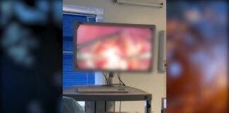 В Шымкенте хирурги провели малоинвазивную операцию пациенту с эхинококкозом